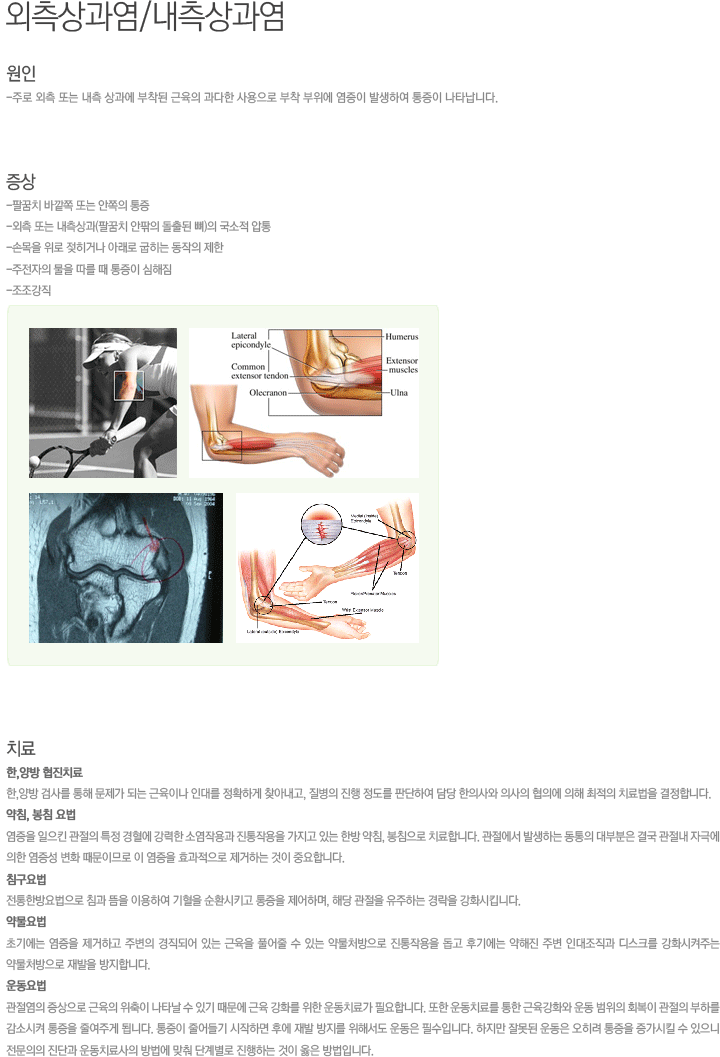 외측상과염